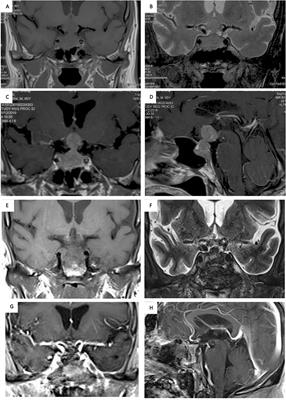 Pituitary Metastasis of Lung Neuroendocrine Carcinoma Mimicking Pituitary Adenoma:Case Report and Literature Review